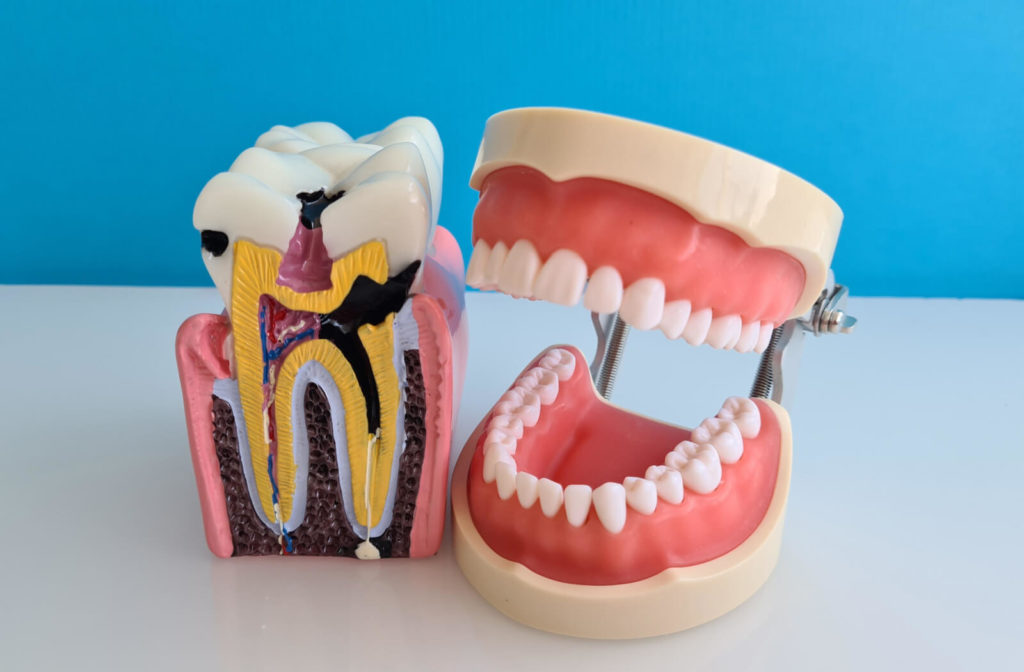 A cross-sectional model of a tooth with cavities beside a plastic model of a mouth.