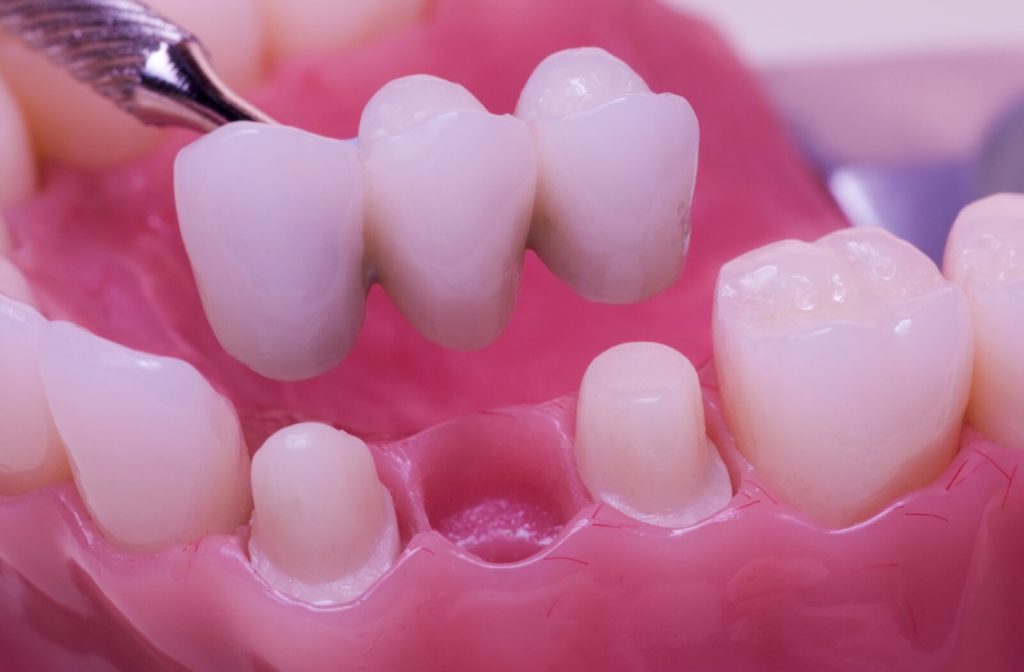 A dental bridge being fitted into a plastic model of a mouth.