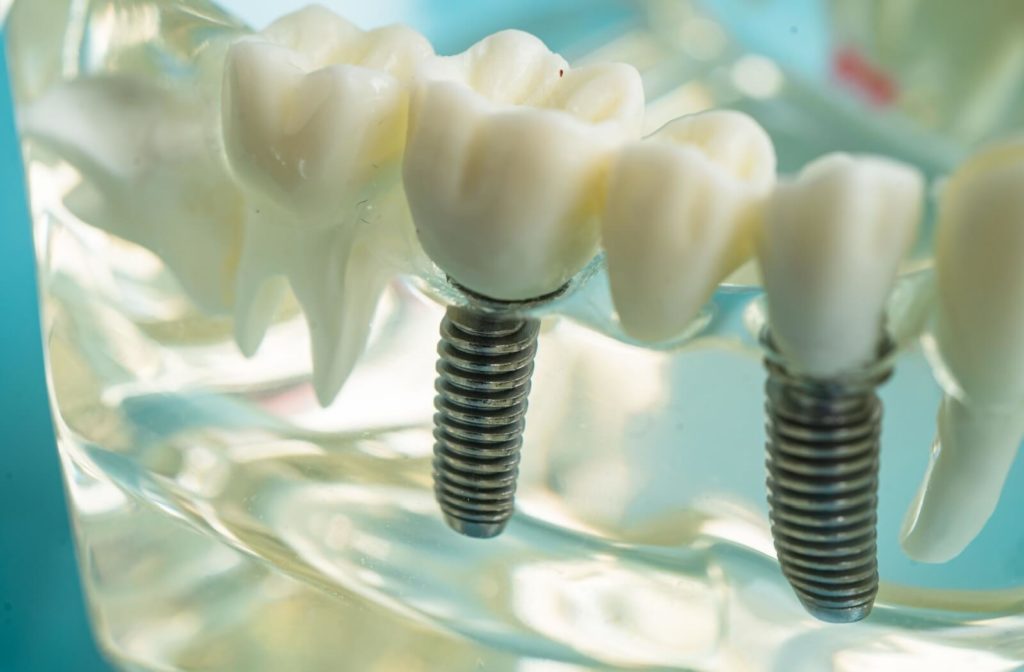 A model of gums & teeth showcasing how dental implants look inside the mouth.