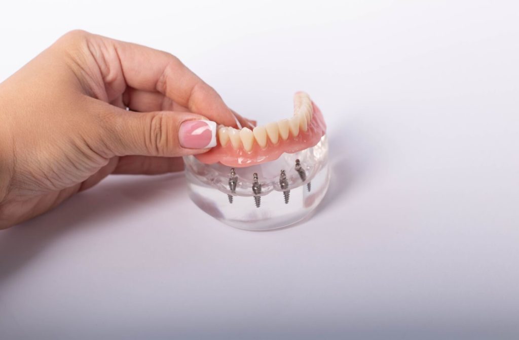 A close-up image of a hand showing off a lower arch of an all-on-4 dental implant on a white background.