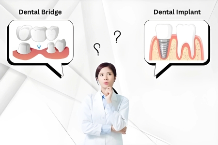 Dental Bridge vs. Implant